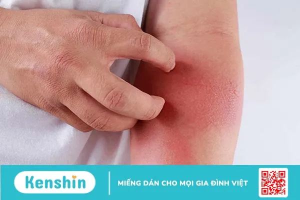 Viêm da dị ứng thời tiết: Nguyên nhân & Cách điều trị