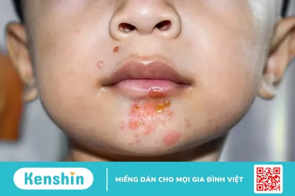 Viêm da liên cầu là bệnh gì? Cách nhận biết và điều trị