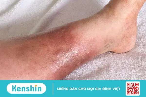 Viêm da liên cầu là bệnh gì? Cách nhận biết và điều trị