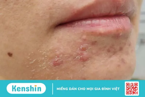 Viêm da quanh miệng là gì và chữa trị viêm da quanh miệng như thế nào?