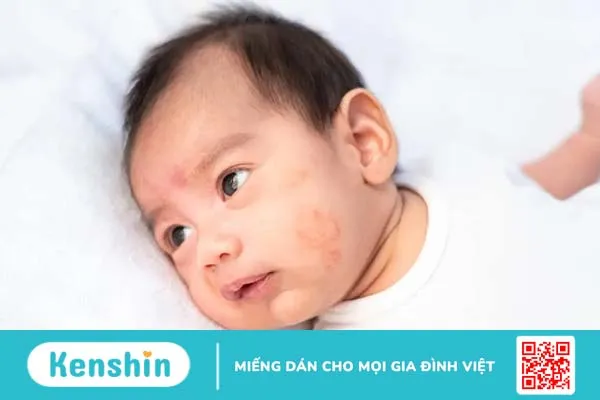 Viêm da tiết bã: Làm sao để sống chung với bệnh dễ dàng?