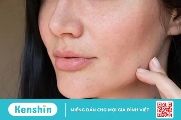 Viêm da tiết bã trên mặt có tự hết không? Nguyên nhân và cách điều trị