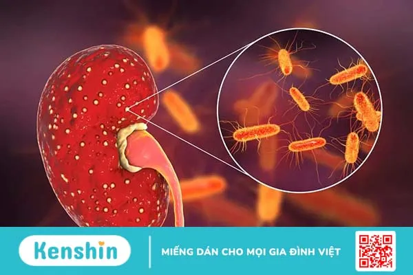 Viêm đài bể thận cấp là gì? Nguyên nhân, triệu chứng và điều trị