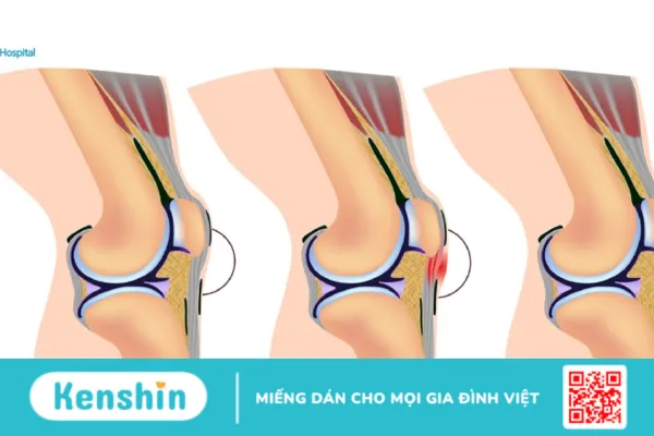 Viêm gân xương bánh chè là bệnh gì ? nguyên nhân và hướng điều trị