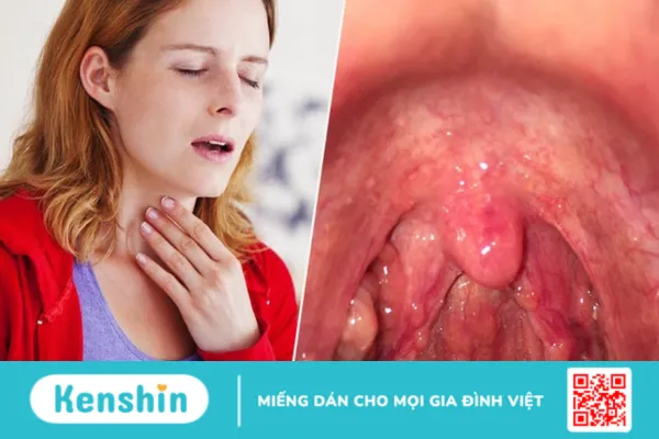 Viêm họng hạt ở lưỡi: Đừng chủ quan khi lưỡi nổi hạt