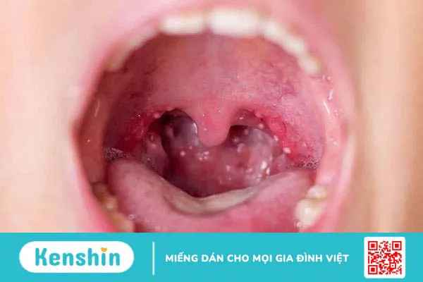 Viêm họng hạt ở lưỡi: Đừng chủ quan khi lưỡi nổi hạt