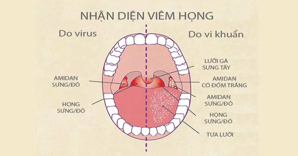 Viêm họng