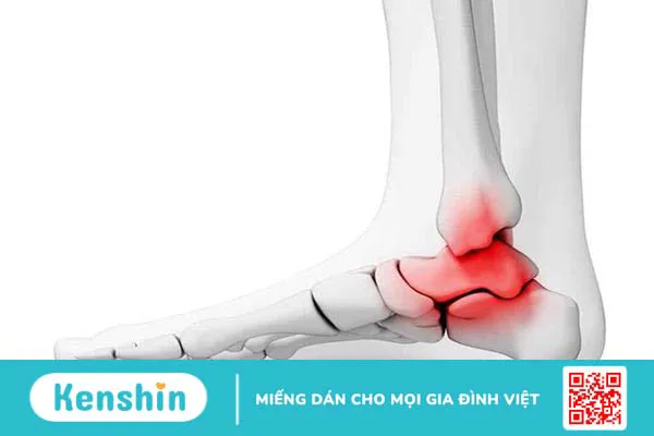 Viêm khớp mắt cá chân