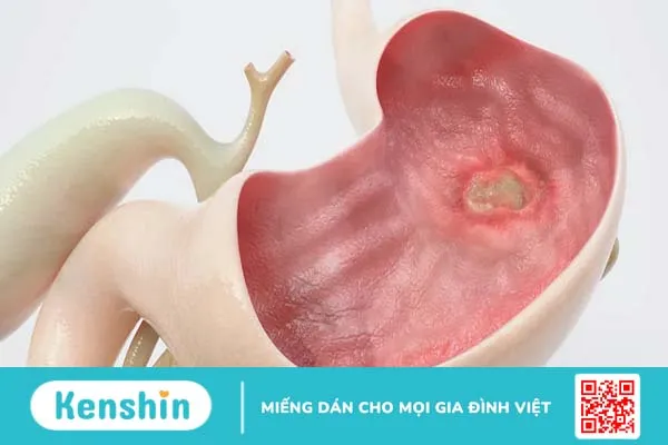 Viêm loét dạ dày có nguy hiểm không? Những ảnh hưởng của bệnh đối với cuộc sống