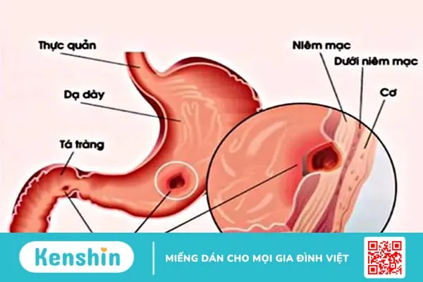 Viêm loét dạ dày khi mang thai gây khó chịu cho mẹ bầu