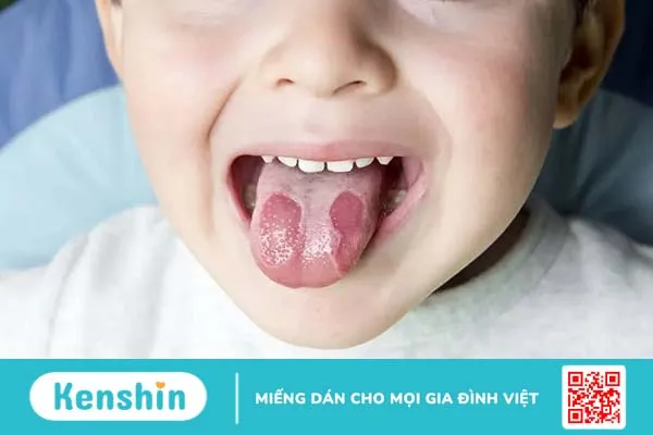 Viêm lưỡi bản đồ là bệnh gì? Nguyên nhân do đâu, phòng ngừa thế nào?