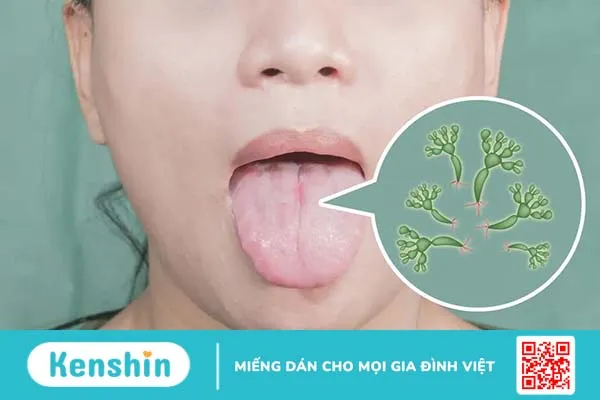 Viêm lưỡi bản đồ là bệnh gì? Nguyên nhân do đâu, phòng ngừa thế nào?