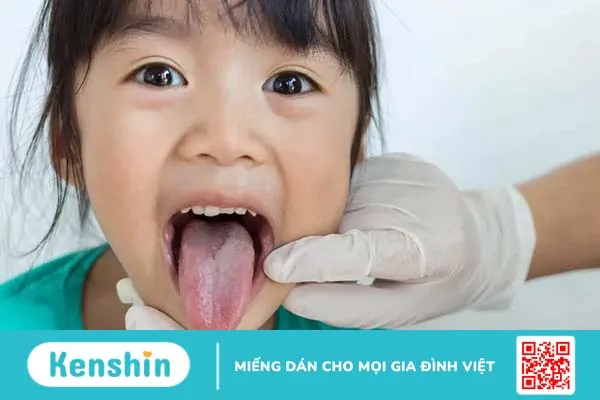 Viêm lưỡi bản đồ là bệnh gì? Nguyên nhân do đâu, phòng ngừa thế nào?