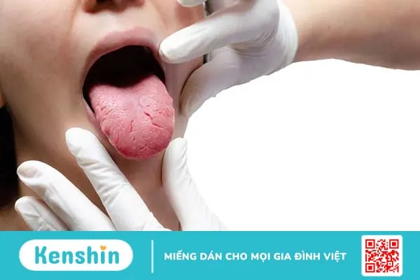 Viêm lưỡi là bệnh gì? Triệu chứng, nguyên nhân và cách điều trị