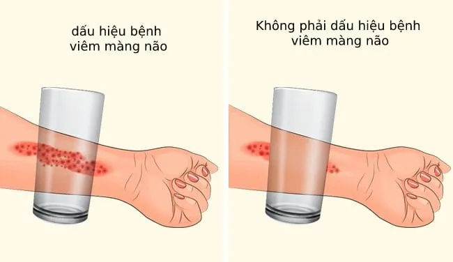 Viêm màng não ở trẻ em: Nguyên nhân, triệu chứng, cách điều trị