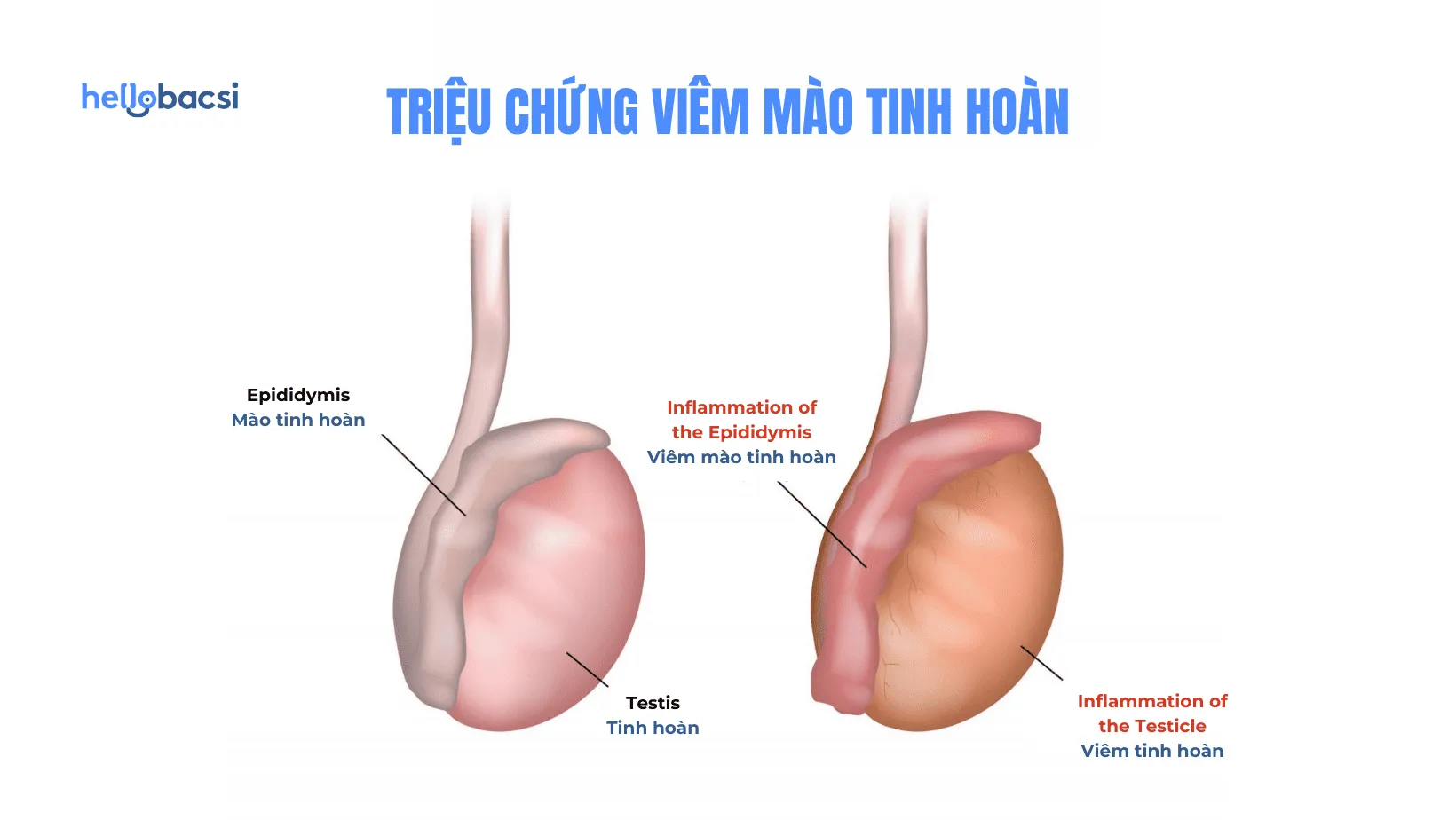 Viêm mào tinh hoàn bao lâu thì khỏi? Có điều trị được không?