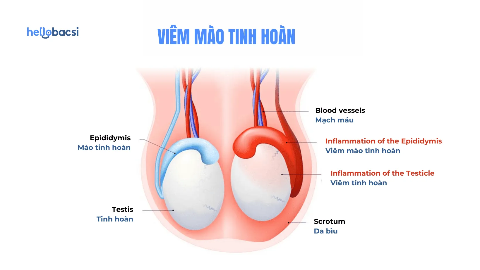 Viêm mào tinh hoàn là gì? Nguyên nhân, triệu chứng, chẩn đoán và điều trị