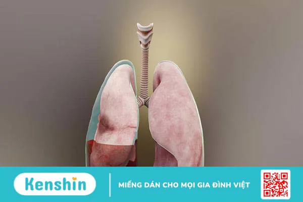 Viêm mủ màng phổi