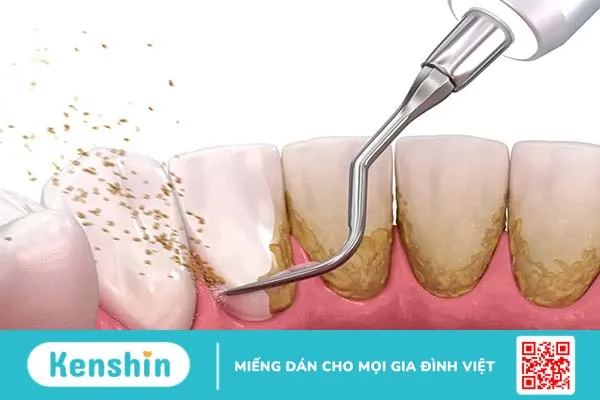 Viêm nha chu có chữa được không? Điều trị ra sao và lúc nào là kịp thời?