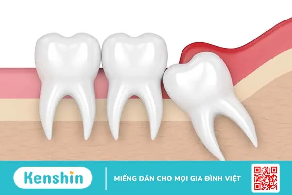 Viêm nướu răng khôn: Những điều cần biết và cách xử lý!