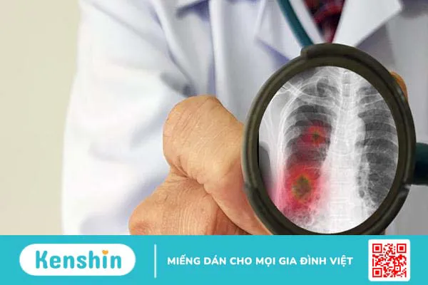 Viêm phổi cấp có nguy hiểm không, điều trị và phòng ngừa như thế nào?