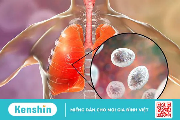 Viêm phổi do nhiễm trùng bào tử Pneumocystis