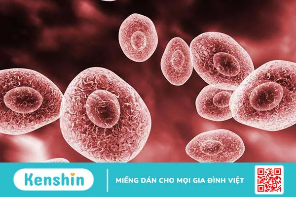 Viêm phổi do nhiễm trùng bào tử Pneumocystis