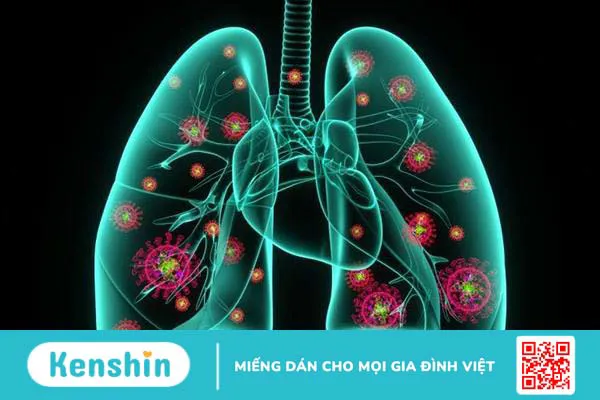 Viêm phổi
