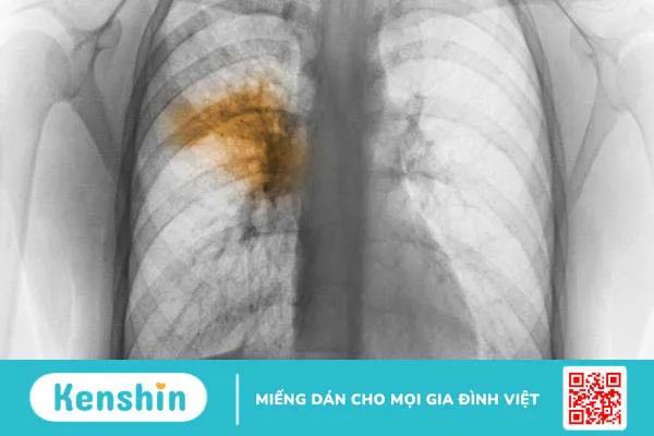 Viêm phổi Viêm phổi