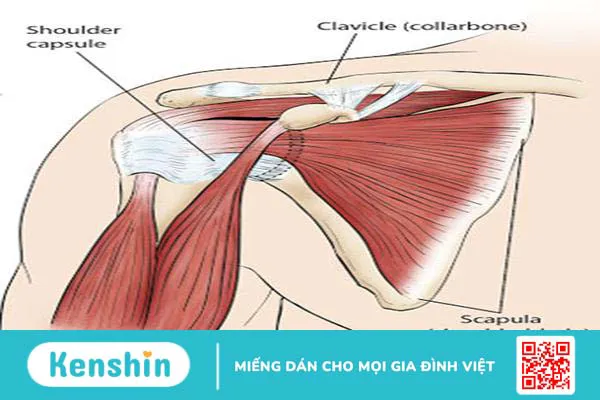 Viêm quanh khớp vai thể đông cứng vai: căn bệnh ít người biết rõ