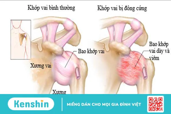 Viêm quanh khớp vai thể đông cứng vai: căn bệnh ít người biết rõ