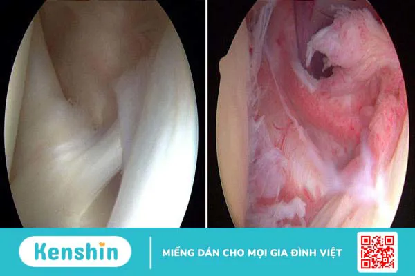 Viêm quanh khớp vai thể đông cứng vai: căn bệnh ít người biết rõ