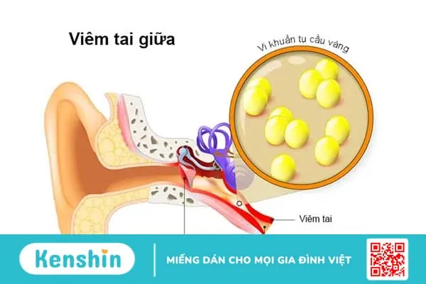 Viêm tai giữa là gì, có gây ảnh hưởng đến thính giác không?