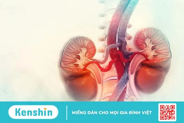 Viêm thận bể thận cấp (viêm bể thận) nguy hiểm như thế nào? Cách nhận biết và điều trị