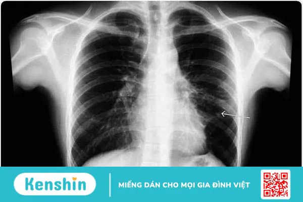 Viêm trung thất là bệnh gì ? nguyên nhân và điều trị như nào ?