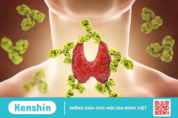 Viêm tuyến giáp Hashimoto là bệnh gì? Triệu chứng & thuốc