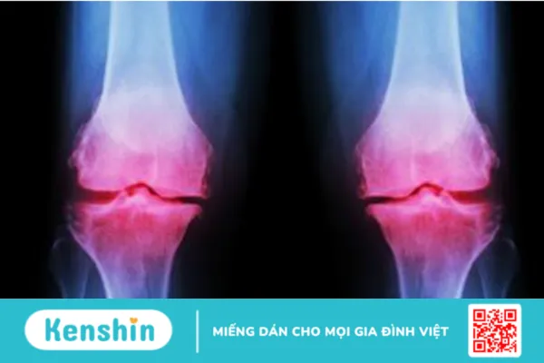 Viêm xương là bệnh gì ? Cách điều trị như nào ?