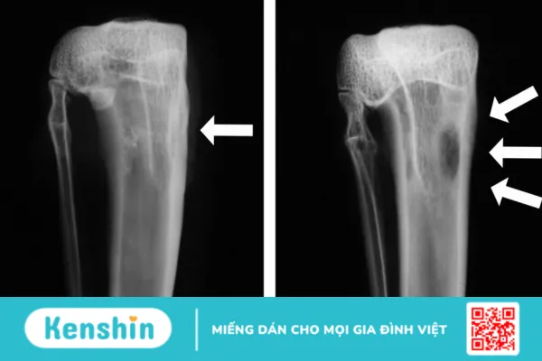 Viêm xương là bệnh gì ? Cách điều trị như nào ?