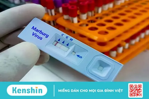 Virus Marburg là gì? Biểu hiện bệnh, con đường lây lan, điều trị và phòng ngừa