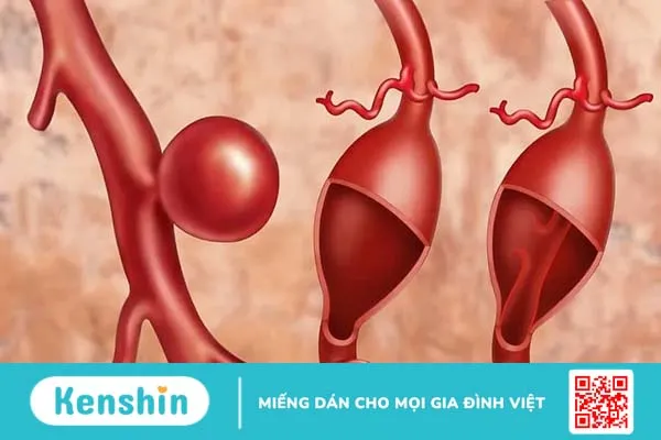 Vỡ phình mạch não (vỡ mạch máu não) là gì? Nguyên nhân, triệu chứng và điều trị