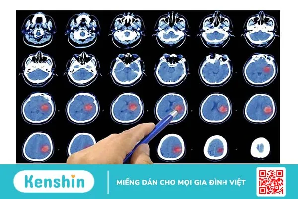 Vỡ phình mạch não (vỡ mạch máu não) là gì? Nguyên nhân, triệu chứng và điều trị