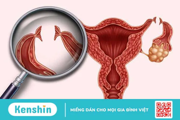 Vô sinh: Nguyên nhân, triệu chứng và cách điều trị