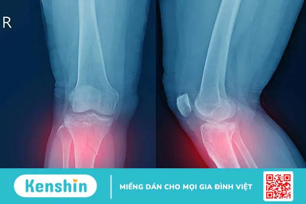 Vỡ xương bánh chè đầu gối: Cách điều trị và bao lâu hồi phục?