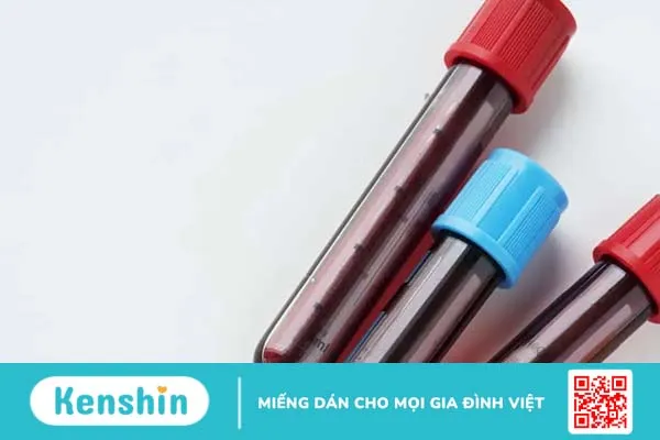 Xét nghiệm testosterone là gì? Quy trình thực hiện ra sao? Xét nghiệm testosterone là gì? Quy trình thực hiện ra sao?
