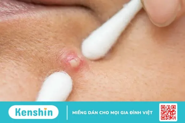 Xử lý từng dạng lỗ chân lông trên da bằng liệu pháp tự nhiên