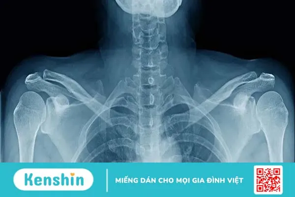 Xương đòn vai là gì? Cấu tạo và chức năng