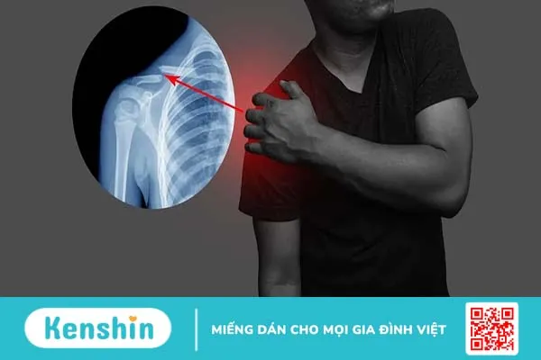 Xương đòn vai là gì? Cấu tạo và chức năng