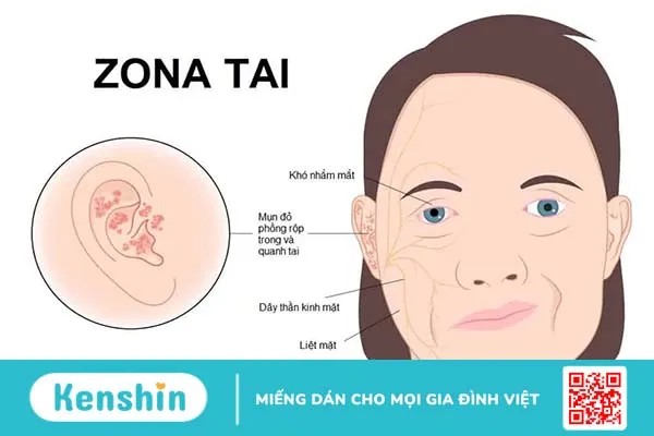 Zona tai có thể gây điếc và liệt mặt vĩnh viễn – Những điều cần biết là gì?