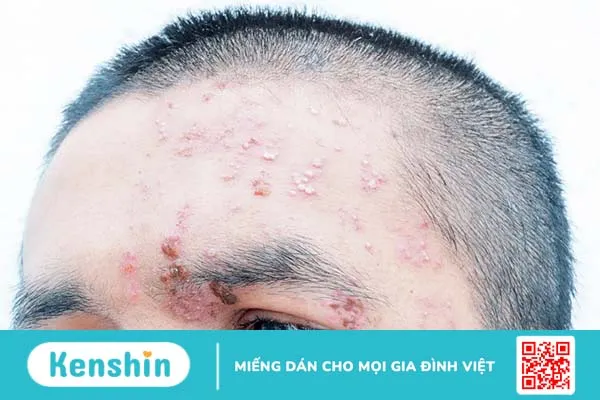 Zona thần kinh ở mắt và những điều liên quan