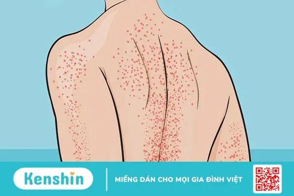 10 câu hỏi nên hỏi về xuất huyết giảm tiểu cầu vô căn